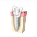 インプラントした歯